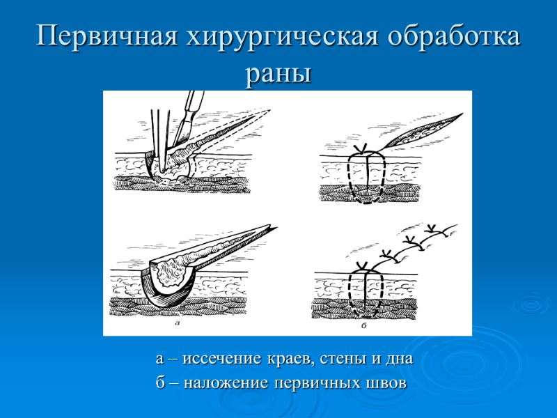 Первичная хирургическая обработка раны   а – иссечение краев, стены и дна 